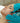 Microdermabrasion